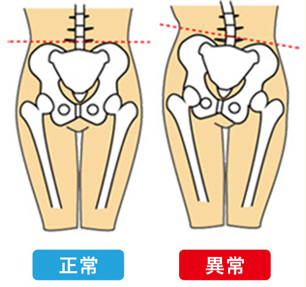 骨盤の歪み